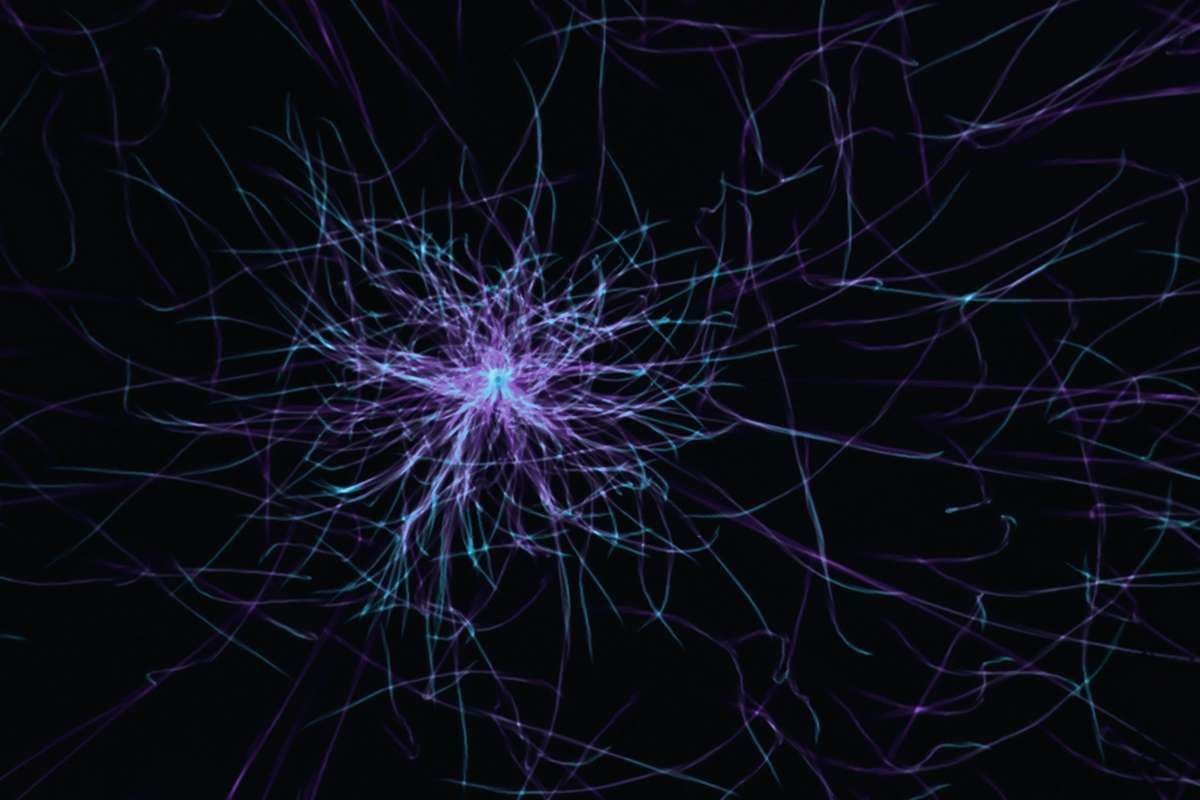 AMBAR Part 3: Plasma Exchange Slows Alzheimer's Decline Regardless of Amyloid Status