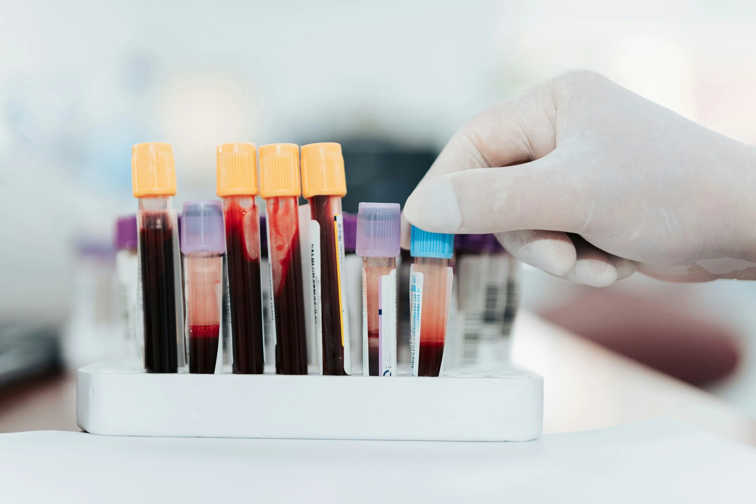 The Biomarker Question: How Do We Measure Success with Therapeutic Plasma Exchange?