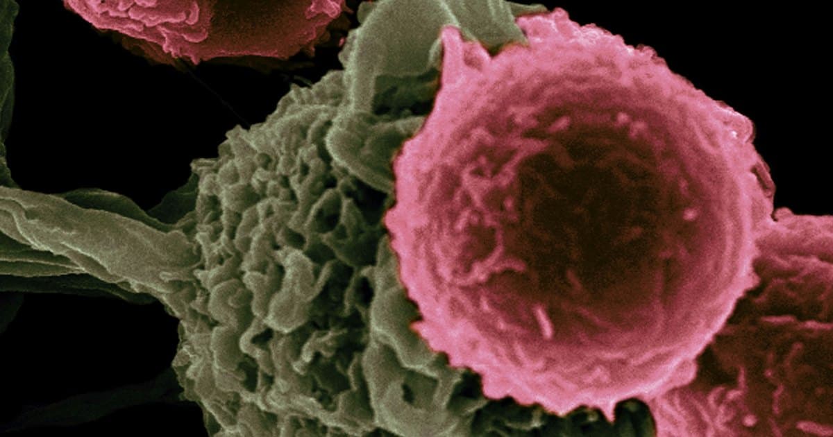 Colorized scanning electron micrograph of T cells clustered around a larger cancer cell.